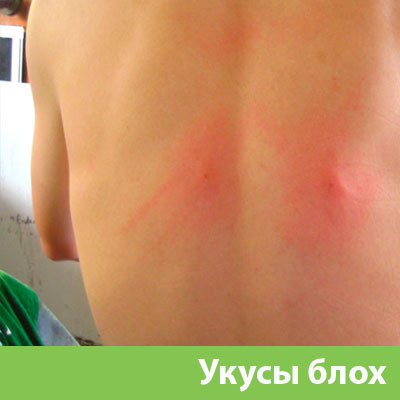 Укусы блох в Орле