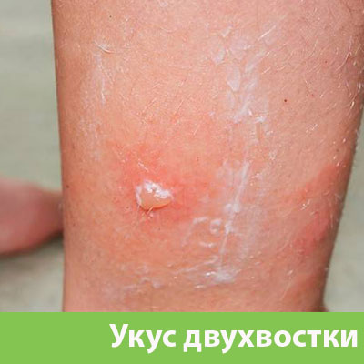 Укус двухвостки в Орле