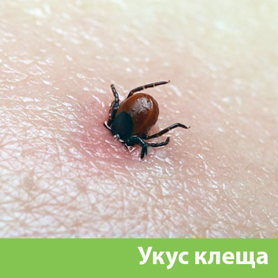Укус клеща в Орле