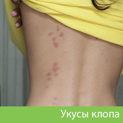 Профессиональное уничтожение клопов в Орле